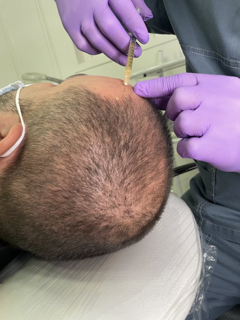 plasma rico en plaquetas